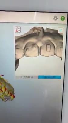 Bạn nghĩ răng bạn có thể di chuyển được bao xa với 7 khay Invisalign