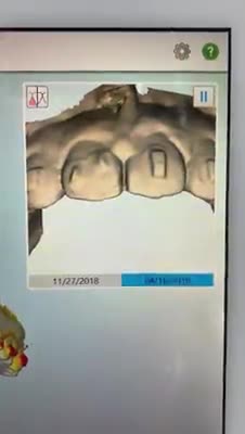 Mô phỏng kết quả niềng răng 3D tại nha khoa Lan Anh: nhanh gọn, rõ ràng, chính xác!