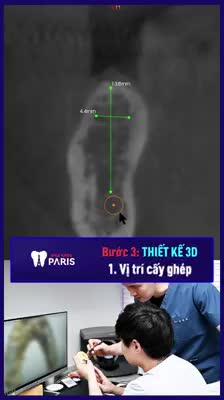 THAY THẾ RĂNG MẤT & GÃY RỤNG CHUẨN XÁC NHƯ THẬT