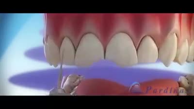QUY TRÌNH DÁN RĂNG SỨ VENEER