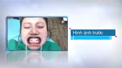 Veneer chính là lớp sứ mỏng được ví như sơn móng tay được dán bên ngoài răng của bạn bằng một loại keo đặc biệt