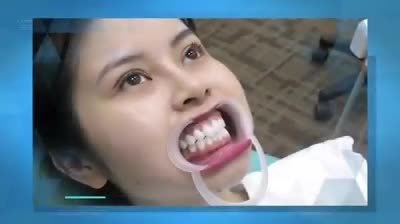 Tạm biệt hàm răng ố vàng, xỉn màu, khấp khểnh chỉ trong tích tắc.