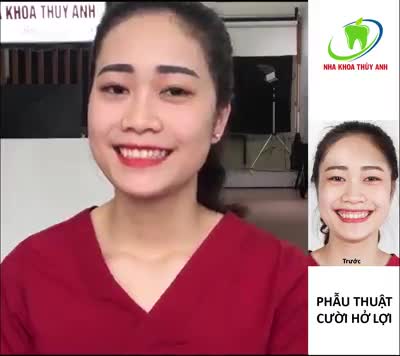 PHẪU THUẬT CƯỜI HỞ LỢI Ở ĐÂU TỐT NHẤT THÁI NGUYÊN?
