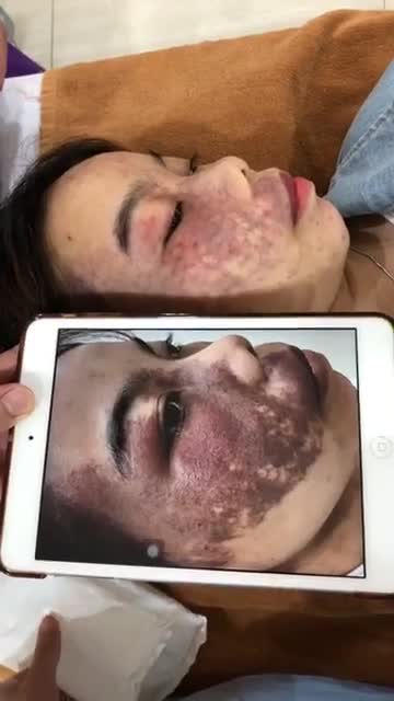Đồng hành cùng bạn gái Trần Huyền đến từ Nghệ An trong quá trình điều trị u máu với công nghệ laser Vbeam !