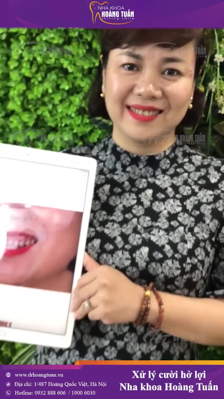 Hết cười hở lợi hoàn toàn chỉ sau 60 phút phẫu thuật và sau 7 ngày cắt chỉ