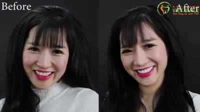DANSUVIETSMILE - MC THANH HUYỀN DÁN SỨ 20 RĂNG