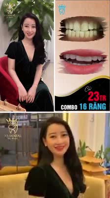 CƠ HỘI VÀNG TRONG LÀNG RĂNG SỨ VỚI COMBO 16 RĂNG NAY CHỈ CÒN 23 TRIỆU