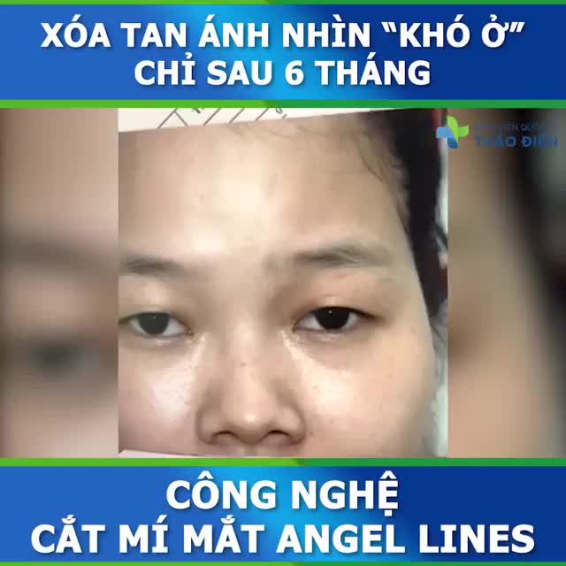 XÓA BỎ ÁNH NHÌN "KHÓ Ở" CHỈ SAU 45 PHÚT!