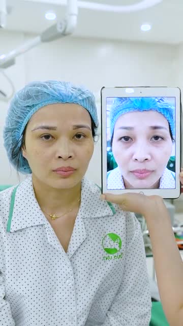 Nâng cung mày chỉ 8TRIỆU | Xóa bỏ hết dấu hiệu lão hóa vùng mắt, da chùng, da thừa ở đôi mắt.
