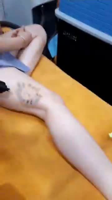 Khách hàng xóa xăm Laser Picosure