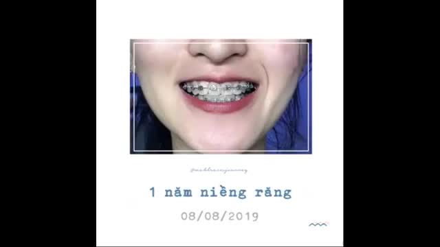 HÀNH TRÌNH 1 NĂM NIỀNG RĂNG