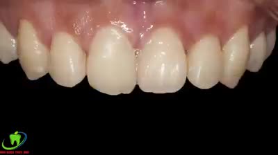 PHẪU THUẬT CƯỜI HỞ LỢI BIẾT TRƯỚC KẾT QUẢ.