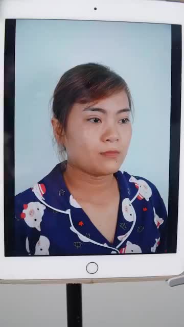 MŨI THẤP, TẸT ĐÃ CÓ PHƯƠNG PHÁP NÂNG MŨI CẤU TRÚC – XEM KẾT QUẢ SAU 8 NGÀY