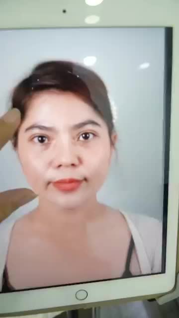 NÂNG MŨI CẤU TRÚC SỬA LẠI VỪA THỰC HIỆN XONG - MŨI ĐẸP HÀI HÒA
