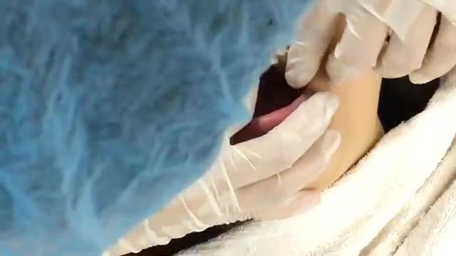 NIỀNG RĂNG TRONG SUỐT INVISALIGN tại Nha Khoa Vân Anh - Từ Sơn - Bắc Ninh