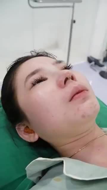 DÁNG MŨI CẤU TRÚC CAO THON VỪA THỰC HIỆN XONG TẠI DR HOẠT