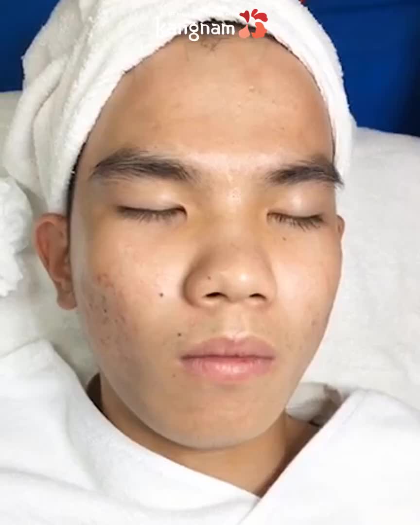 Chàng trai 2 năm đi chữa mụn khắp nơi không khỏi