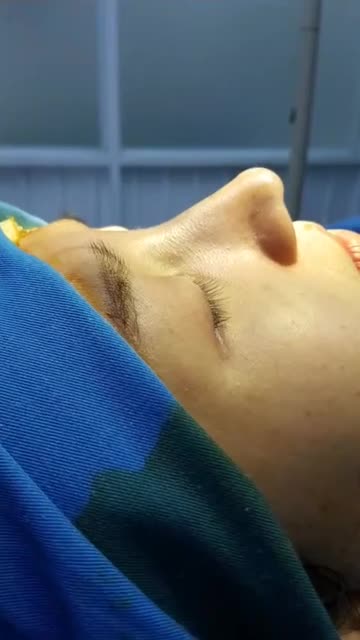 Nâng mũi bán cấu trúc