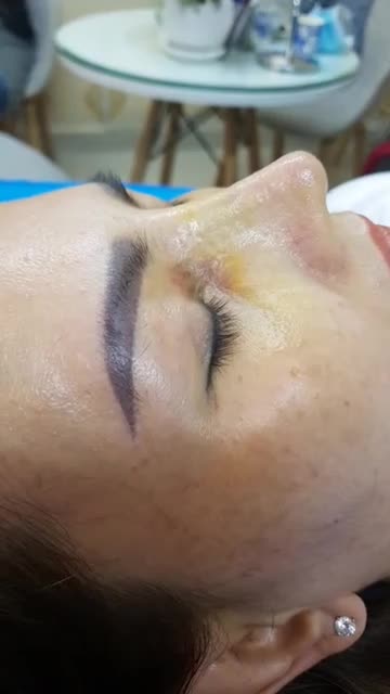Nâng mũi sụn tai 2 lớp