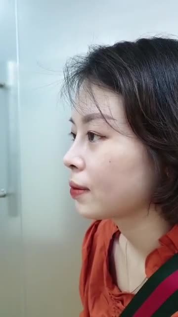 Dáng mũi Sline sau 1 tháng