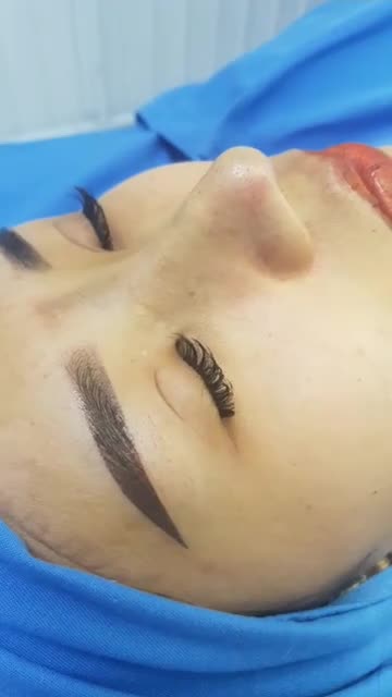 Nâng mũi sụn tai 2 lớp