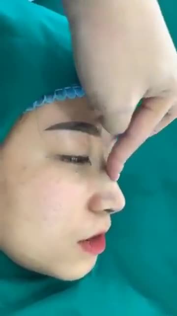 Xử Lý Mũi Dò Mồm