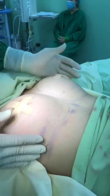 Nâng Ngực Nội Soi Chân Không