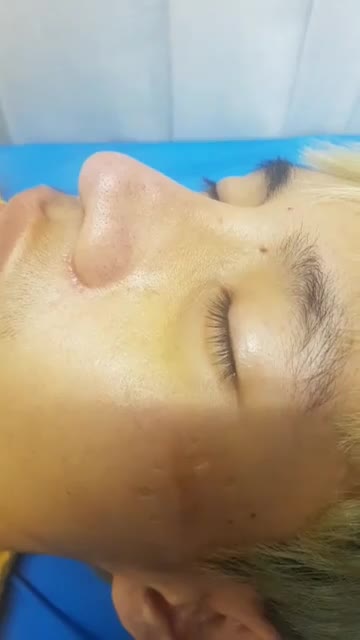 Nâng mũi cấu trúc đa lớp