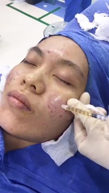 Quy trình CẤY DA SIÊU VI ĐIỂM | LÀM ĐẦY sẹo lõm, rỗ