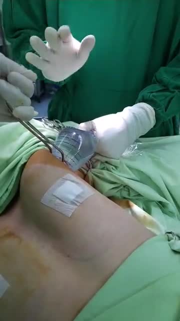 Nâng Ngực Nội Soi Chân Không là gì