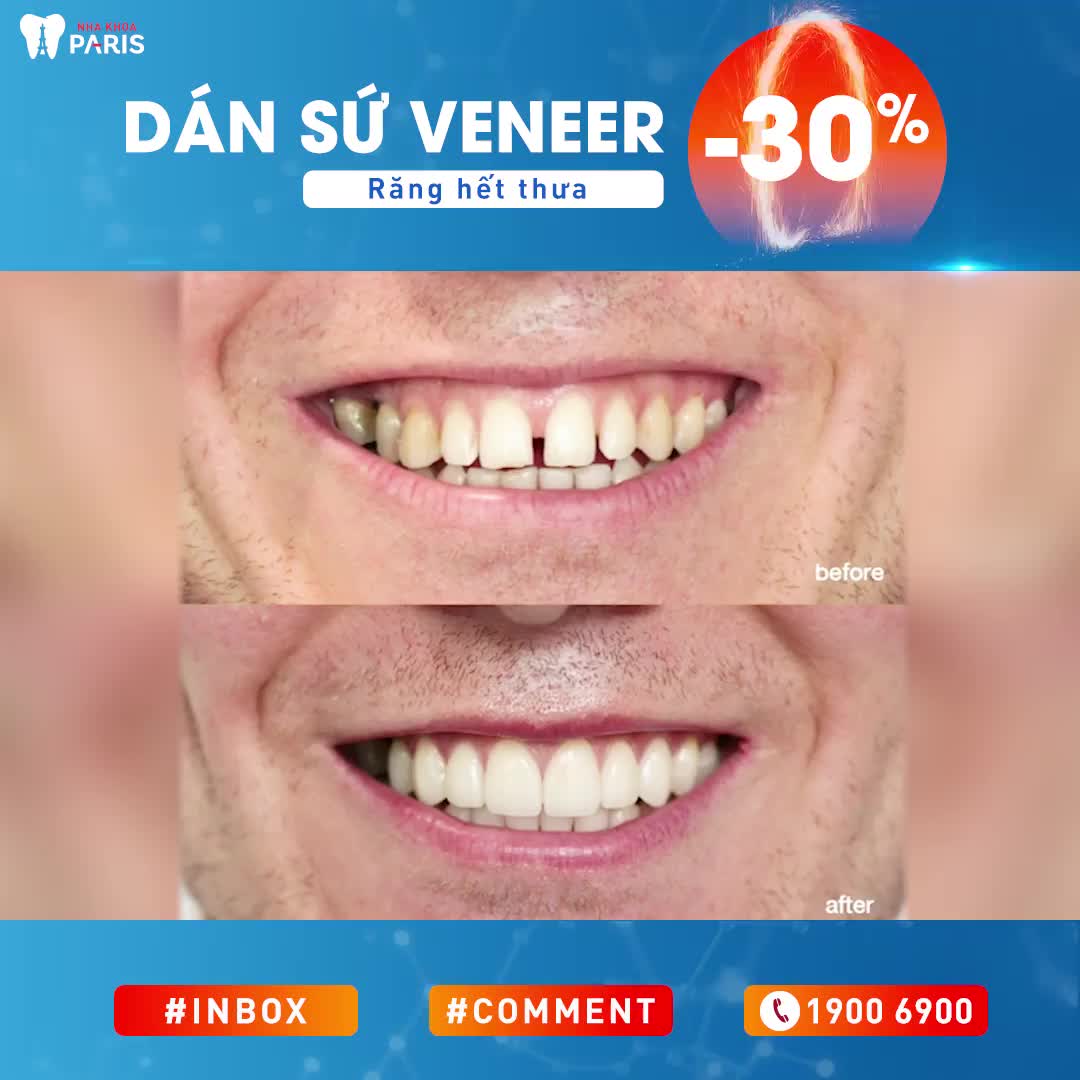 10 Năm RĂNG THƯA Gió Lùa 02 Ngày DÁN SỨ Răng Đều Đẹp Ngay