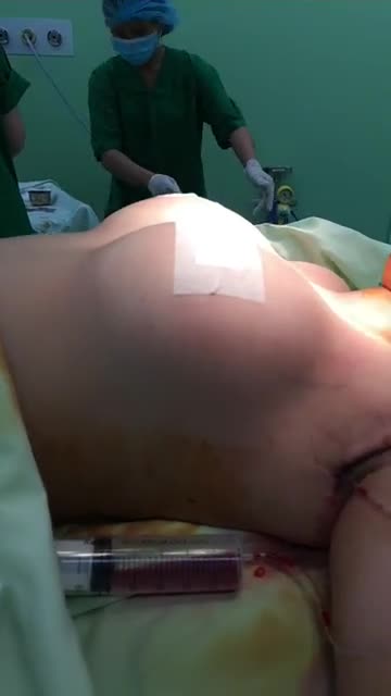 Nâng ngực nội soi chân không