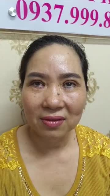 Cắt 2 mí đuôi phượng