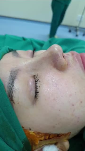 Nâng mũi bán cấu trúc 2 lớp