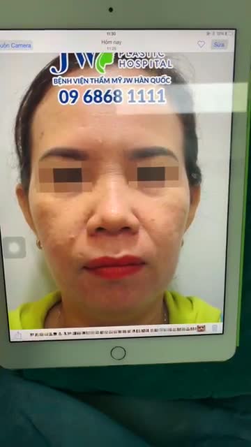 5 ƯU ĐIỂM VƯỢT TRỘI CỦA PHƯƠNG PHÁP NÂNG MŨI CẤU TRÚC S LINE