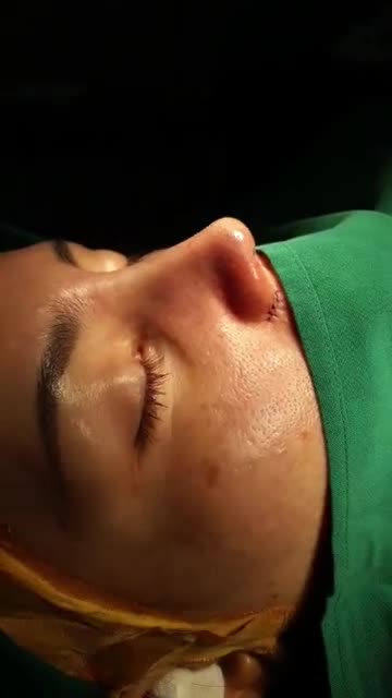 Nâng mũi bán cấu trúc đa lớp
