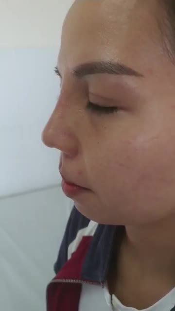 Nâng mũi sụn tai 2 lớp