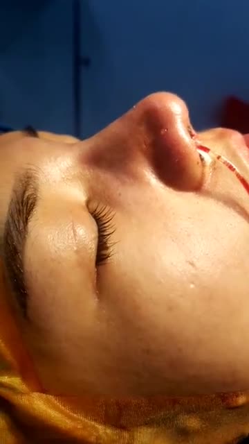 Nâng mũi cấu trúc đa lớp