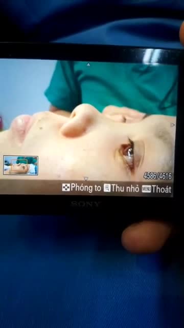 Nâng mũi sụn tai 2 lớp