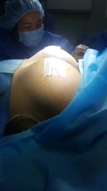 Nâng ngực nội soi chân không