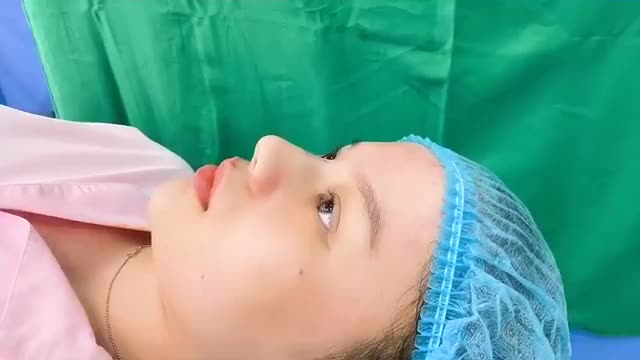 CẬN CẢNH DÁNG MŨI CỰC SANG NGAY SAU KHI NÂNG TẠI VIỆN THẨM MỸ JK