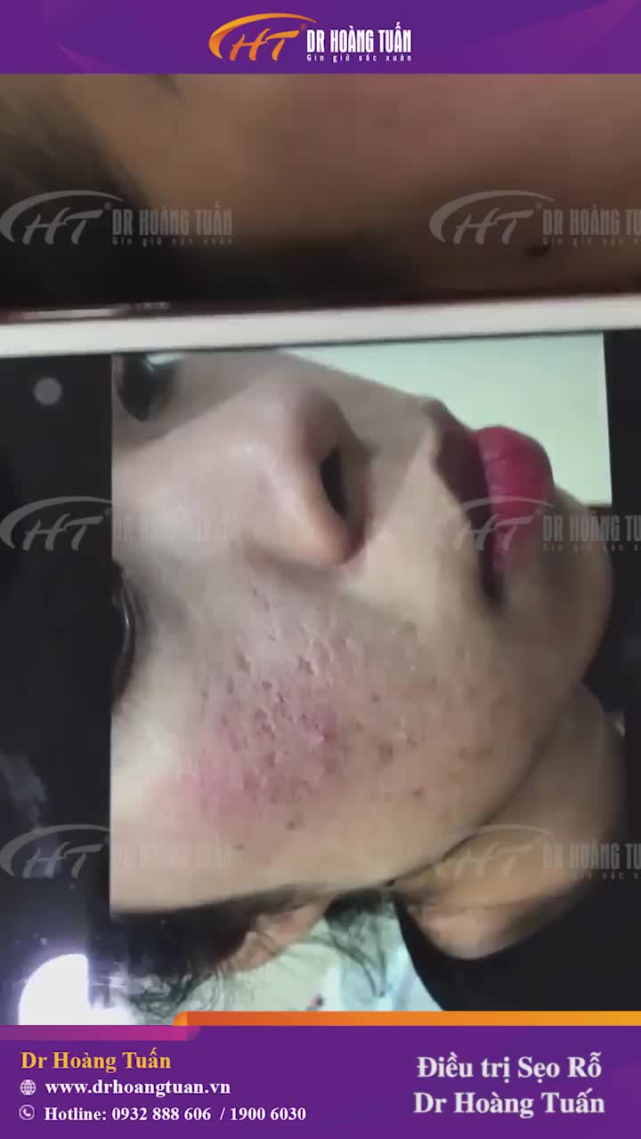 Thanh xuân này đã không còn sợ sẹo rỗ do mụn để lại