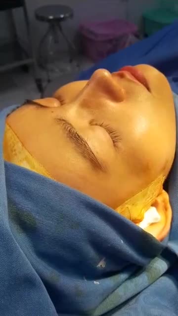 Nâng mũi cấu trúc đa lớp