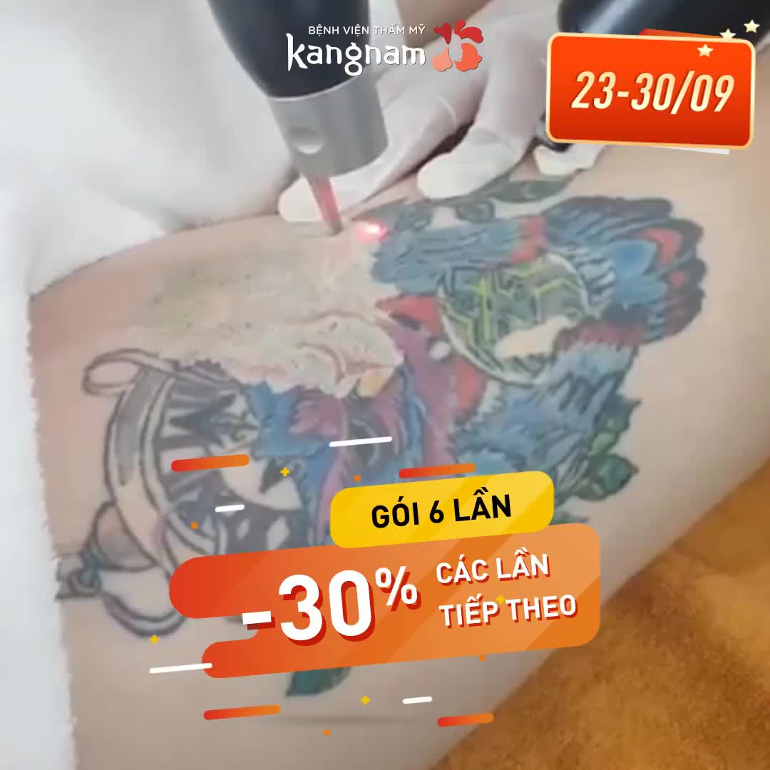 XÓA XĂM giá tốt nhất  Giảm đến 70%