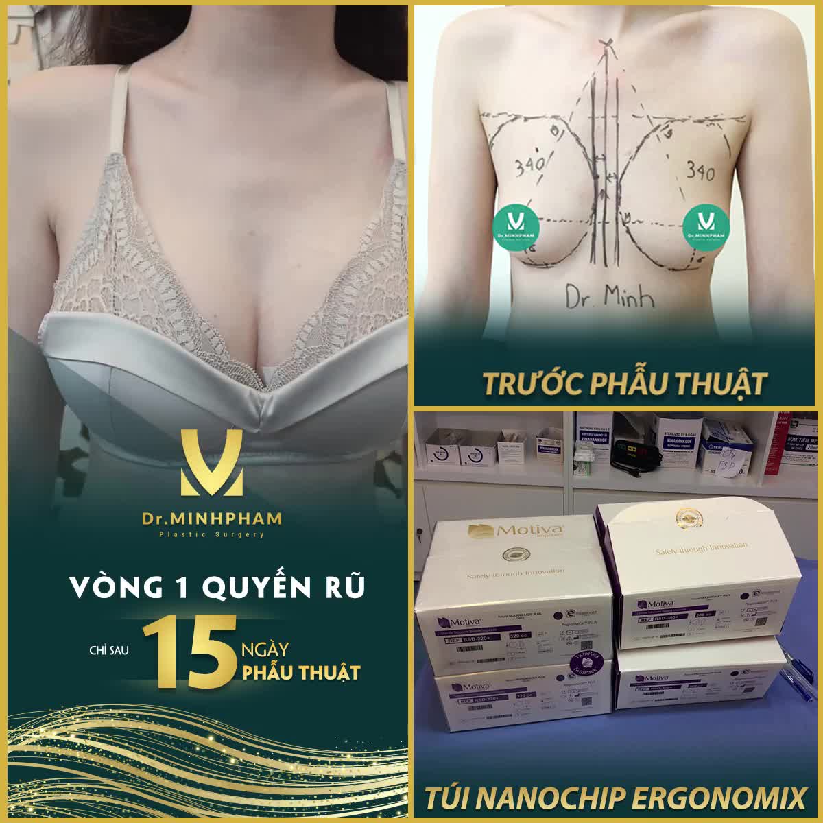 NGỰC ĐẸP TỰ NHIÊN SAU MỘT LẦN NÂNG CẤP
