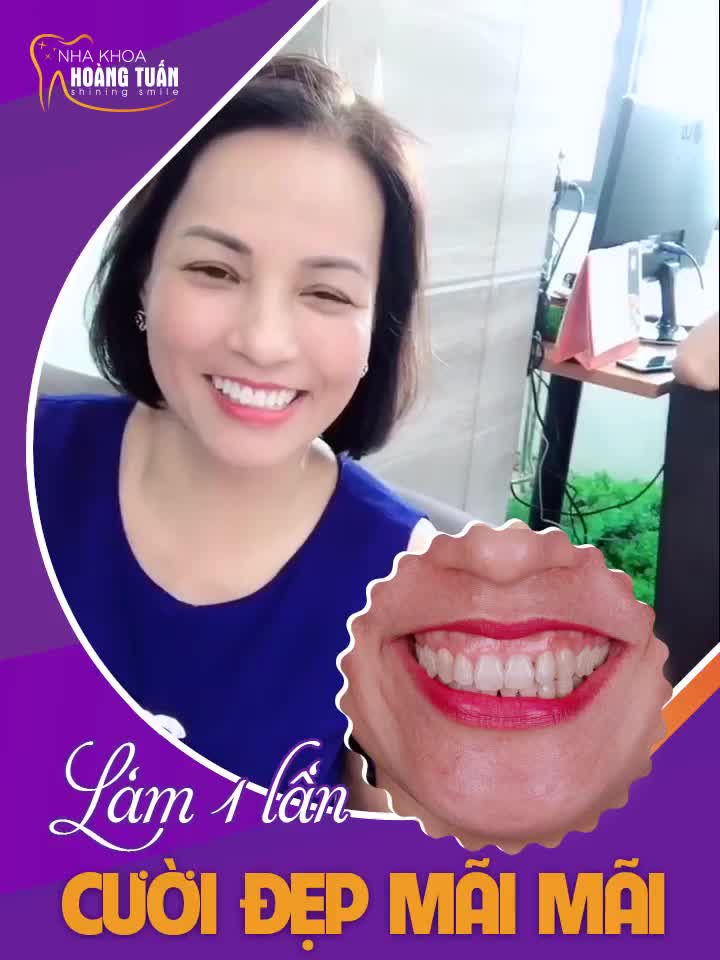 LÀM RĂNG 1 LẦN CƯỜI ĐẸP MÃI MÃI