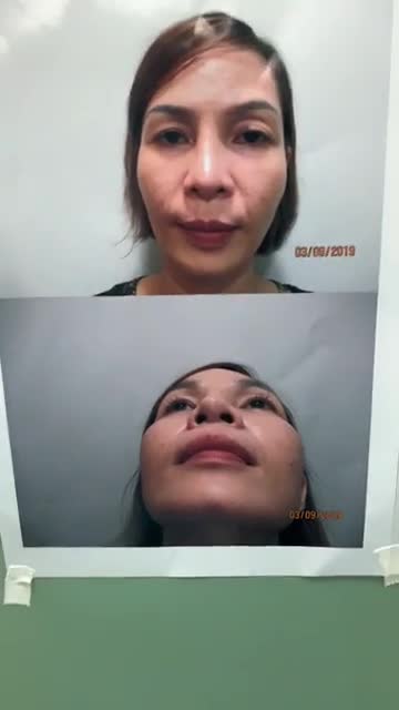 CẬN CẢNH QUÁ TRÌNH GIẢI CỨU MŨI LỘ SÓNG TẠI BỆNH VIỆN JW