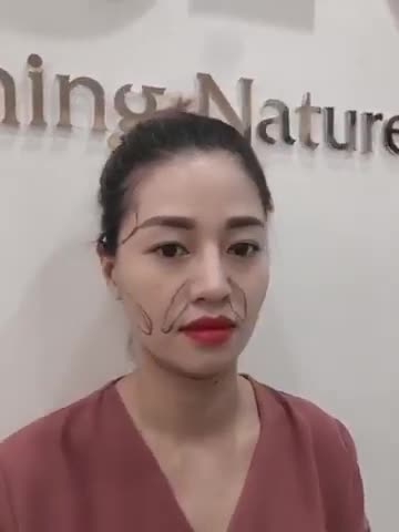 CHIÊM NGƯỠNG DÁNG MŨI " SIÊU ĐẸP TỰ NHIÊN" LÀM TẠI JK ĐƯỢC 1 NĂM