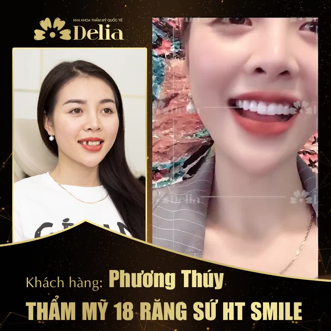 RĂNG TRẮNG - MÔI XINH - NỤ CƯỜI TỎA NẮNG