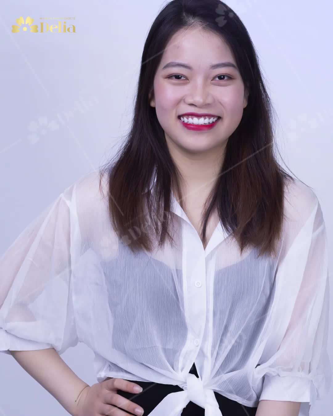 "Khuôn mặt cũng không đến nỗi nhưng hàm răng không đẹp nên giao tiếp không tự tin" - KH Đỗ Linh chia sẻ